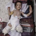 Gaza toddlers got the polio vaccine, then an Israeli bomb took their legs